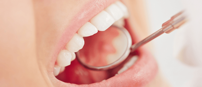 How To Remove Plaque From Teeth