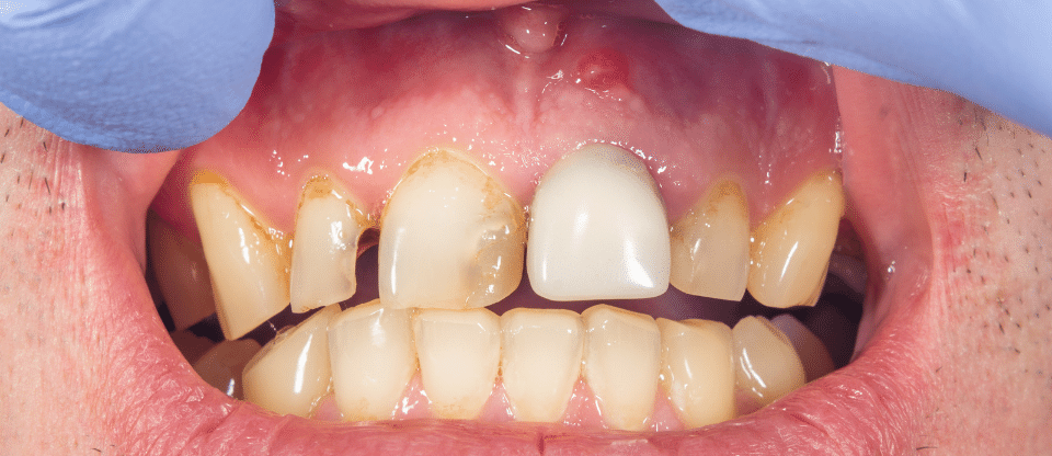 Populations With Poor Oral Hygiene