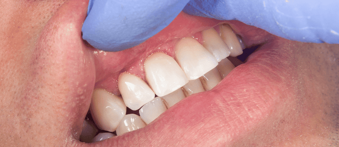 What Can Result From Poor Oral Hygiene?