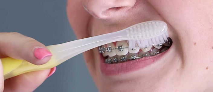 Top Tips for Maintaining Good Oral Hygiene with Braces